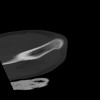 SPORK, NICO - 22.03.1976 - 02.08.2022 - CT obere Extremität - 18:02:23